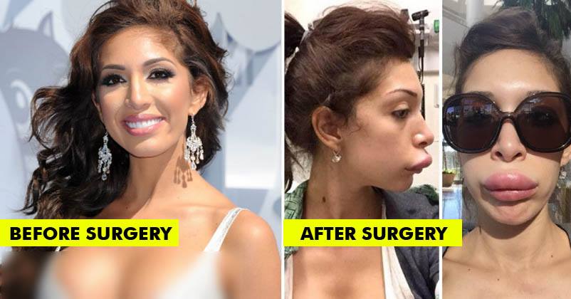 Before-And-After Plastic Surgery Disasters.