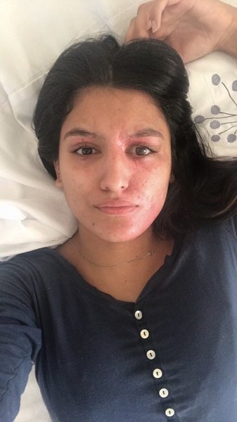 Acid Attack Survivor Shares How She Looks Like Without Makeup After Viral Post Recovery Tweet - RVCJ Media