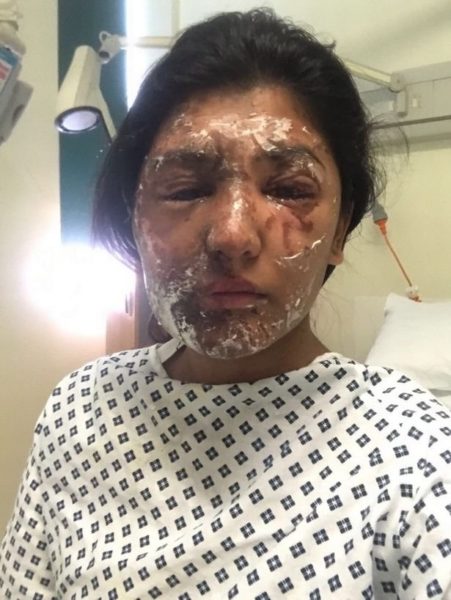 Acid Attack Survivor Shared Her New Look After Recovery. Twitter Is Loving It - RVCJ Media