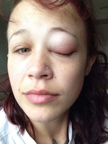 Woman Got Totally Blind From One Eye After Getting An Eye Tattoo. Her Story Will Make You Cry 6 Woman Got Totally Blind From One Eye After Getting An Eye Tattoo. Her Story Will Make You Cry - RVCJ Media
