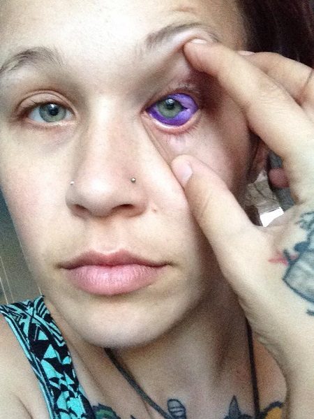 Woman Got Totally Blind From One Eye After Getting An Eye Tattoo. Her Story Will Make You Cry 3 Woman Got Totally Blind From One Eye After Getting An Eye Tattoo. Her Story Will Make You Cry - RVCJ Media