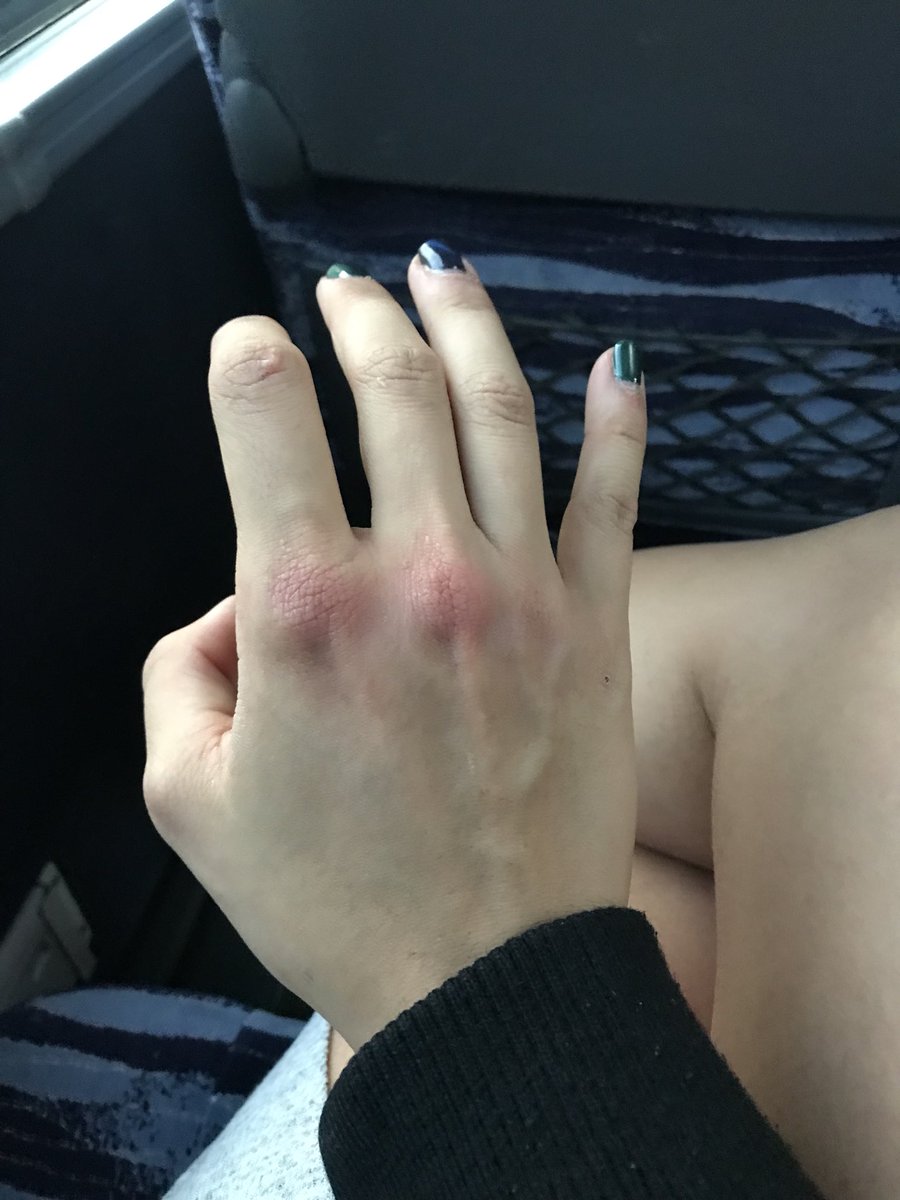 swollen knuckles RVCJ Media