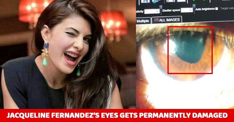Jacqueline Fernandez's Eye Gets Permanently Injured. We Are Feeling Very Sad For Her RVCJ Media