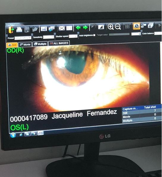 Jacqueline Fernandez's Eye Gets Permanently Injured. We Are Feeling Very Sad For Her - RVCJ Media