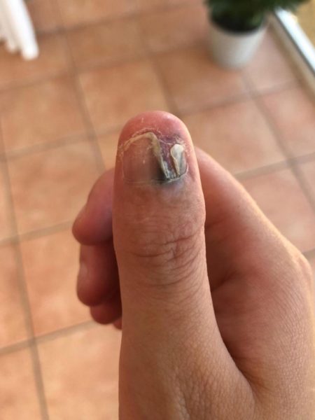 20-Yr Girl Used To Bite Nails & Got A Rare Form Of Cancer, Her Thumb Might Be Cut Off - RVCJ Media
