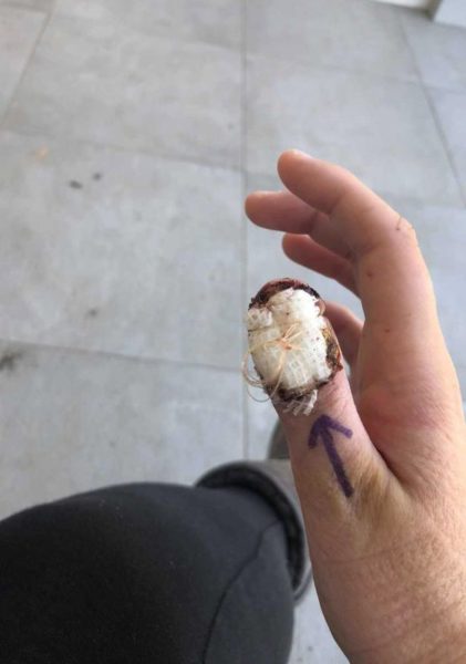 20-Yr Girl Used To Bite Nails & Got A Rare Form Of Cancer, Her Thumb Might Be Cut Off - RVCJ Media