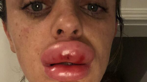 This Woman's Lips Swelled Up 3 Times More The Original After Beauty Treatment. It's A Nightmare RVCJ Media