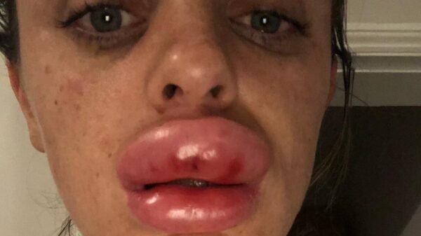 This Woman's Lips Swelled Up 3 Times More The Original After Beauty Treatment. It's A Nightmare - RVCJ Media