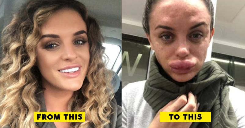 This Woman's Lips Swelled Up 3 Times More The Original After Beauty Treatment. It's A Nightmare RVCJ Media