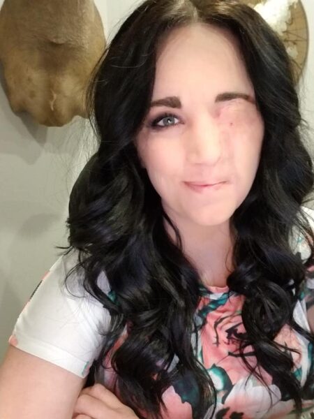Inspirational Mother Needed Skin Transplant For Falling On Her Face On A Hot Curling Rod - RVCJ Media