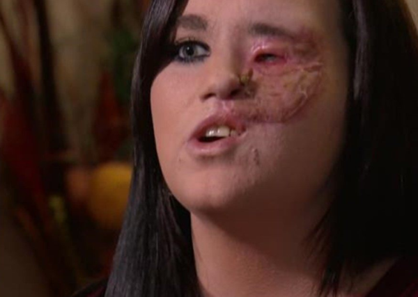 Inspirational Mother Needed Skin Transplant For Falling On Her Face On A Hot Curling Rod - RVCJ Media