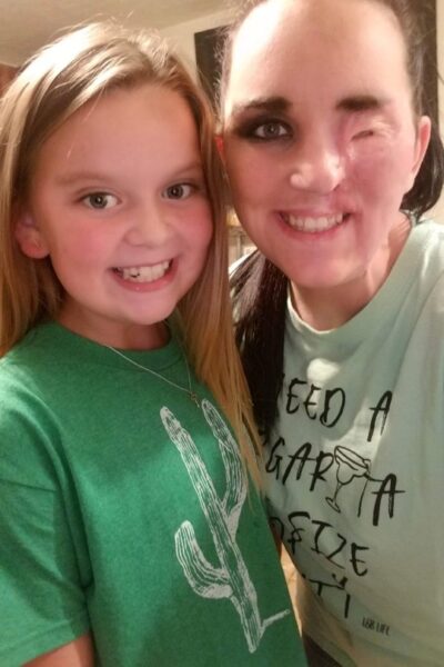 Inspirational Mother Needed Skin Transplant For Falling On Her Face On A Hot Curling Rod - RVCJ Media