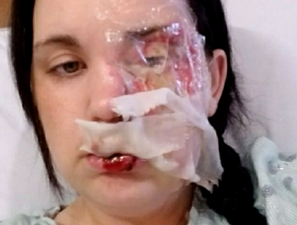 Inspirational Mother Needed Skin Transplant For Falling On Her Face On A Hot Curling Rod - RVCJ Media