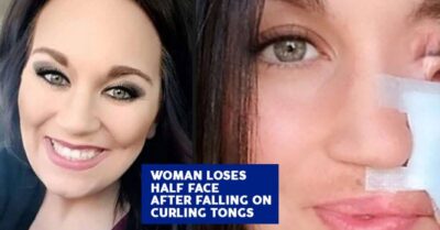 Inspirational Mother Needed Skin Transplant For Falling On Her Face On A Hot Curling Rod RVCJ Media