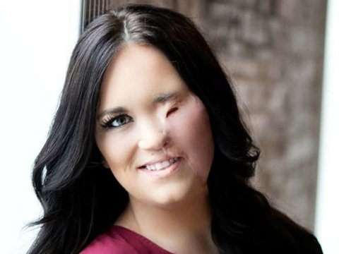 Inspirational Mother Needed Skin Transplant For Falling On Her Face On A Hot Curling Rod - RVCJ Media