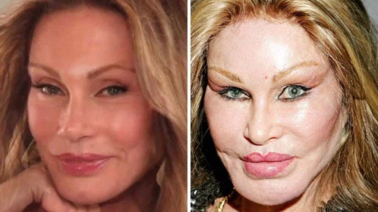 10 Times Celebrities' Plastic Surgeries Turned To Disasters - RVCJ Media