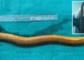 Bizarre- Surgeons Remove 1-Foot-Long Live Eel From Chinese Man’s Stomach 3 “You Are Done,” Dinesh Karthik Took A Dig At Ravi Shastri While Talking About His Last Test