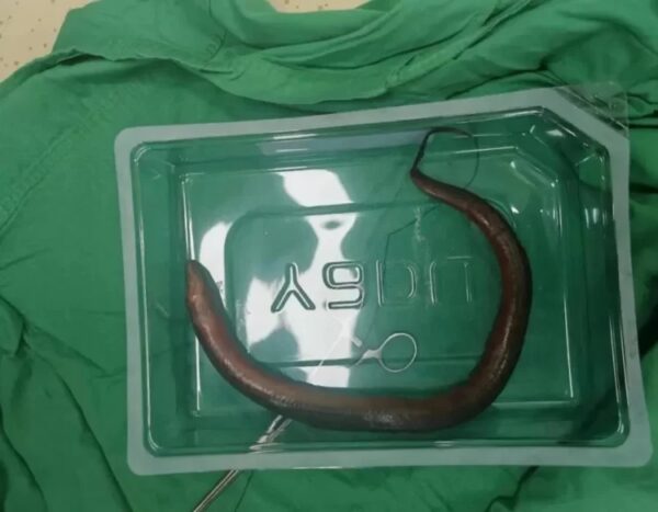Bizarre- Surgeons Remove 1-Foot-Long Live Eel From Chinese Man’s Stomach - RVCJ Media